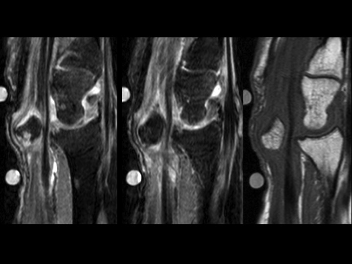 Figure 4 for case Lunate dislocation